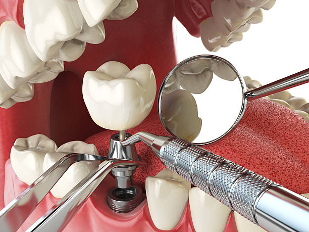 Best Broken or Chipped Tooth Repair in Huntsville, AL